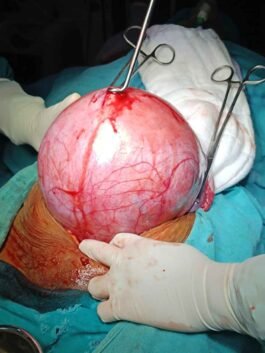 Adenomyosis :